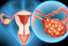 Photo of Ovarian Cyst होने पर शरीर में नजर आते हैं ये लक्षण, जानें कारण और बचाव के तरीके