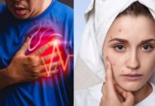 Photo of स्‍क‍िन पर नजर आएं ये 5 लक्षण ताे समझ जाएं बीमार हो गया है आपका Heart