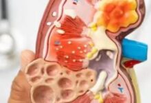 Photo of यूरिन में नजर आते हैं किडनी डैमेज के संकेत