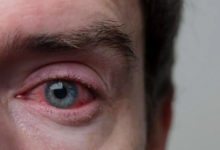 Photo of जिसे साधारण एलर्जी समझ रहे हैं, कहीं वो अर्बन आई सिंड्रोम तो नहीं?