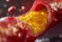 Photo of क्या बिना किसी लक्षण के शरीर में बढ़ सकता है कोलेस्ट्रॉल? 